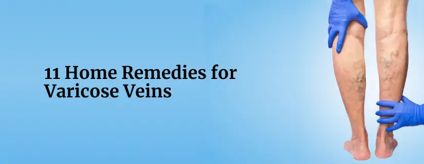 Home Remedies for Varicose Veins