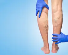 Home Remedies for Varicose Veins