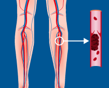 Deep vein Thrombosis