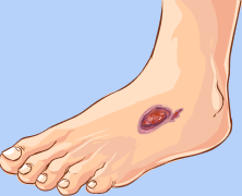 Diabetic Foot Ulcer