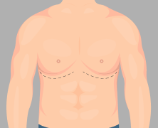 Gynecomastia