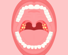 Tonsil Stones