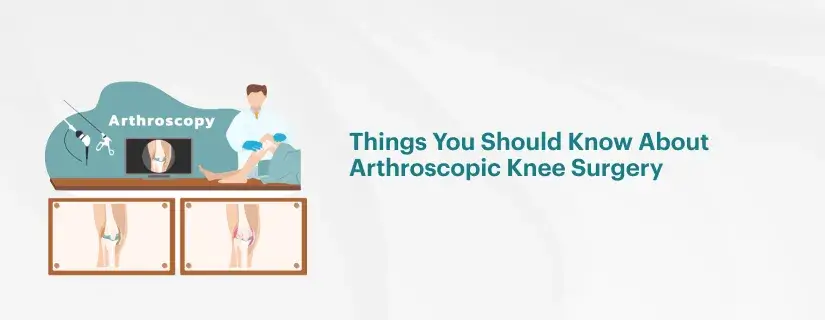 Things You Should Know About Arthroscopic Knee Surgery