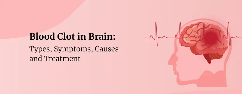 Blood Clot in Brain