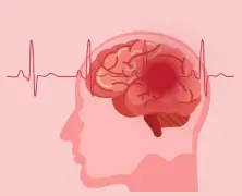 Blood Clot in Brain