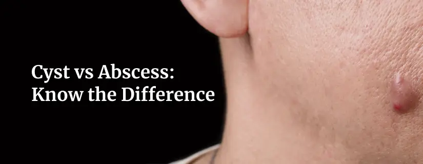 Difference Between Cyst and Abscess