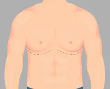 Gynecomastia