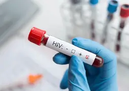 HIV and AIDS: Symptoms, Causes, Prevention and Treatments