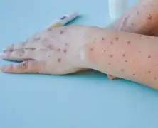 Mpox