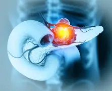 Pancreatic cancer