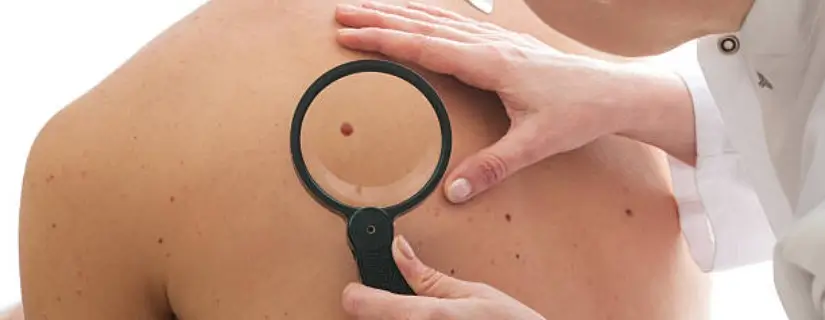 Various Skin Cancers and their Signs and Symptoms