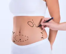 Tummy Tuck Surgery