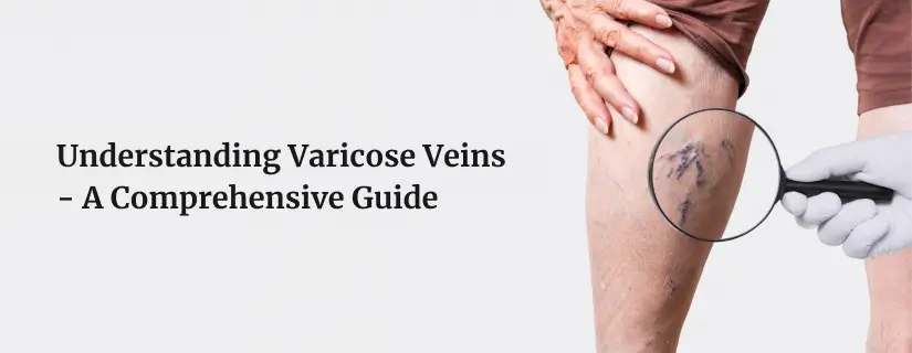 Varicose Veins