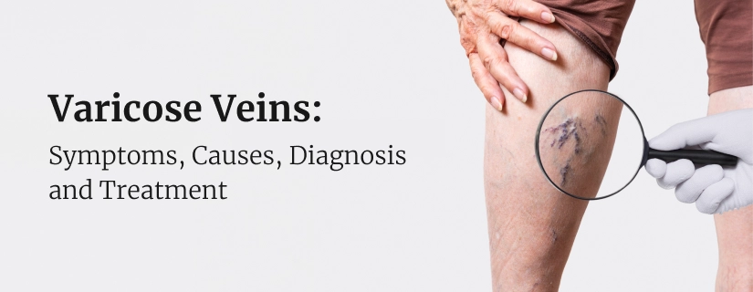 https://www.carehospitals.com/assets/images/main/varicose-veins-causes-symptoms-treatment.webp