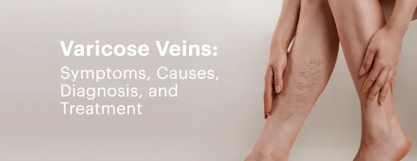 Varicose veins