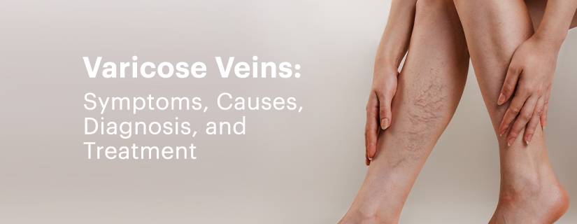 Here's How to Treat Varicose Veins - The Right Way