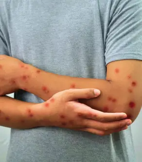 Key Symptoms of Mpox