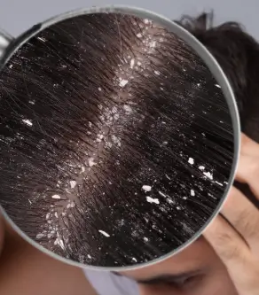 Home Remedies for Dandruff