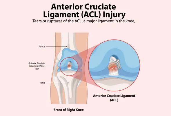 ACL Injury