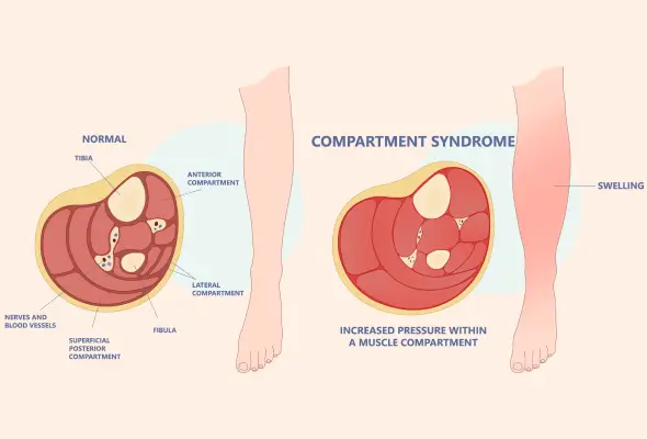 Acute Limb Ischemia