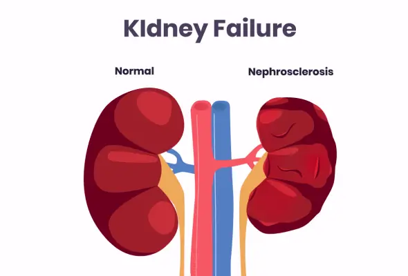 Acute Renal Failure