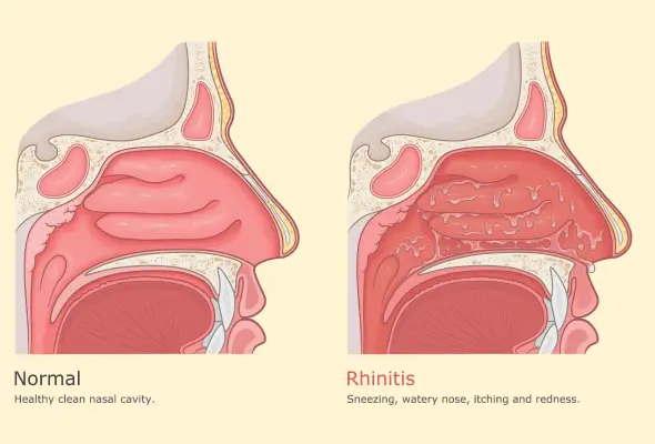 allergic-rhinitis