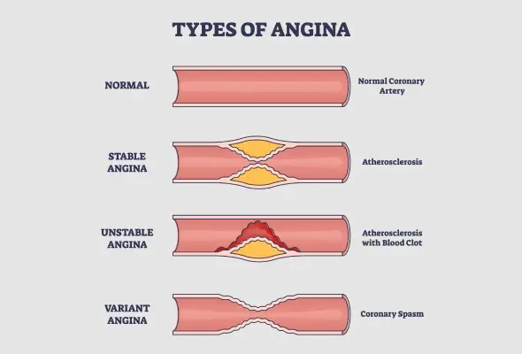 angina-types