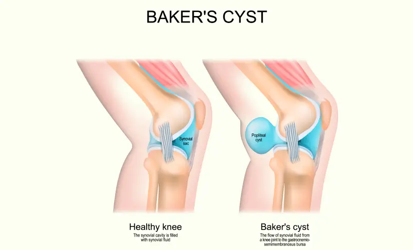 Bakers Cysts