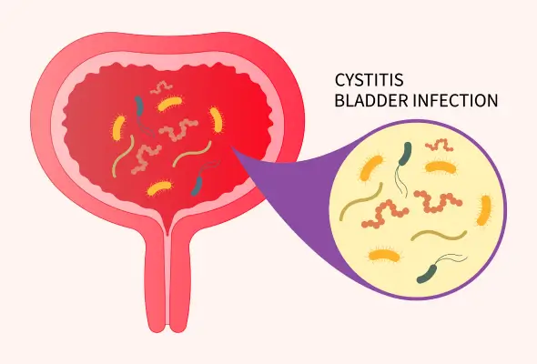 bladder-infections