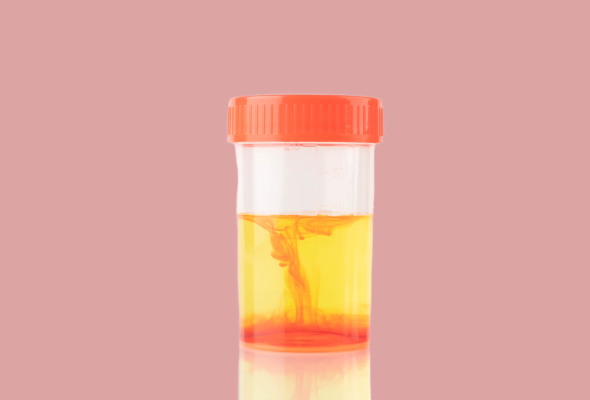 Urine Brown Discharge, Blood in the urine can look pink, red or cola-colored .