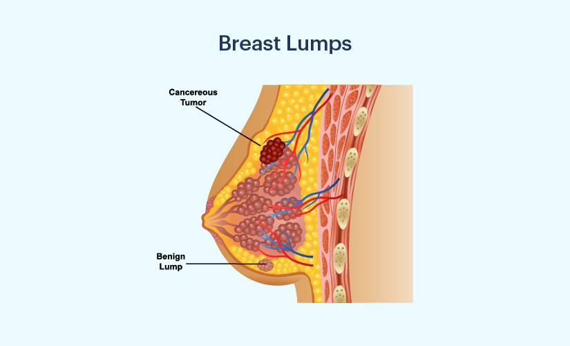 Breast lump Information
