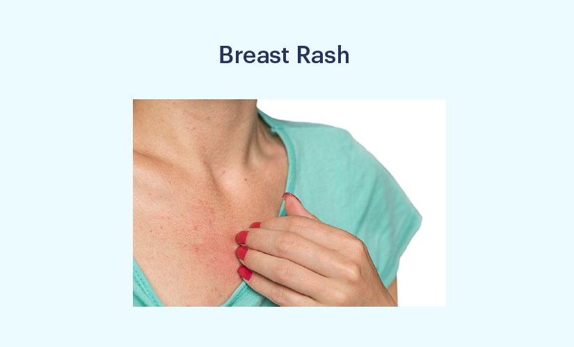 What can be a red rash in between breasts? - Quora