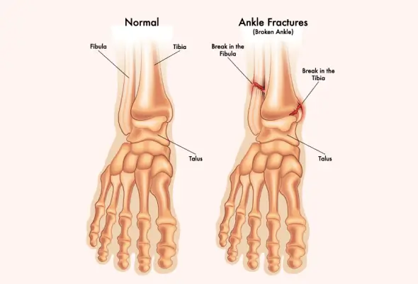 broken-ankle