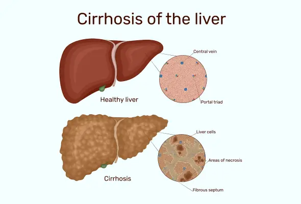 cirrhosis