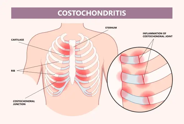 Nursing Paper Example on Costochondritis