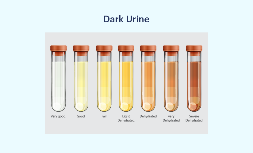 dark yellow urine symptoms
