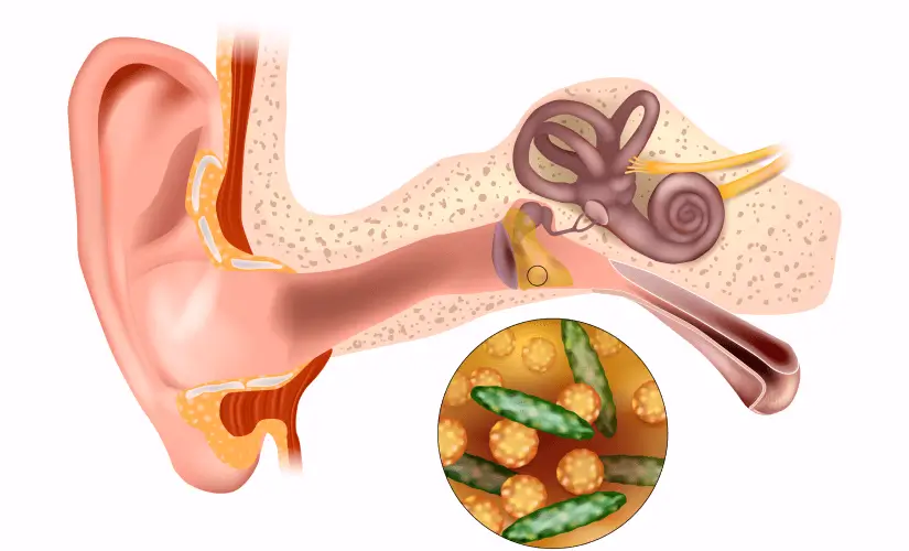 ear-infection-on-tinnitus