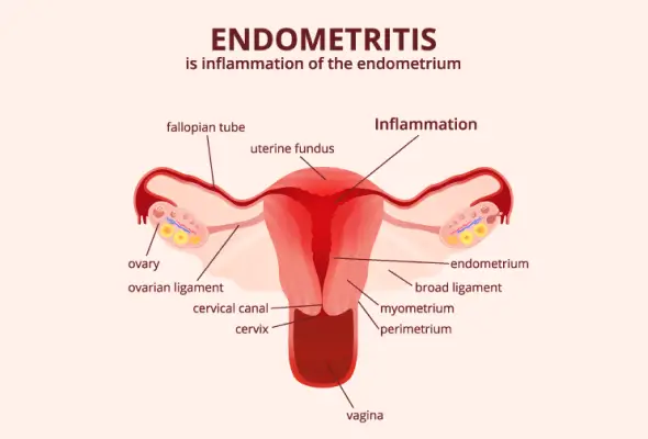 endometriosis