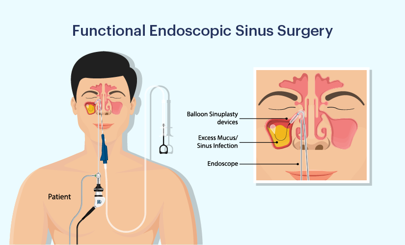 Endoscopic sinus surgery