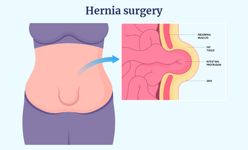 Hernia Surgery Cost in Hyderabad, India