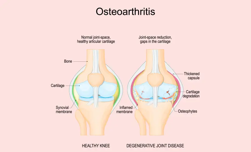 Osteoarthritis