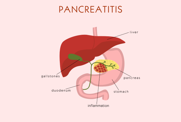 pancreatis-diet