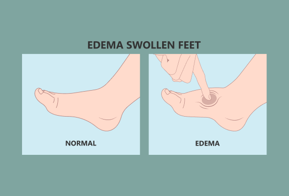Why do you have only one swollen foot ?