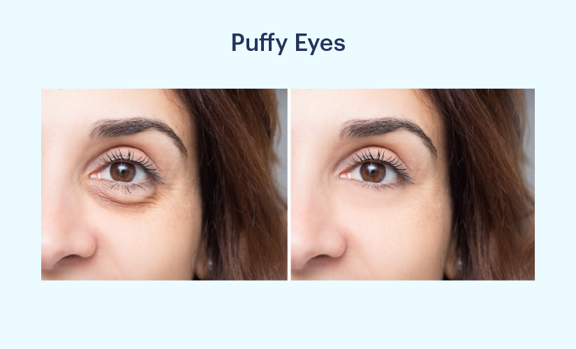Tips To Reduce Puffy Eyes In The Morning