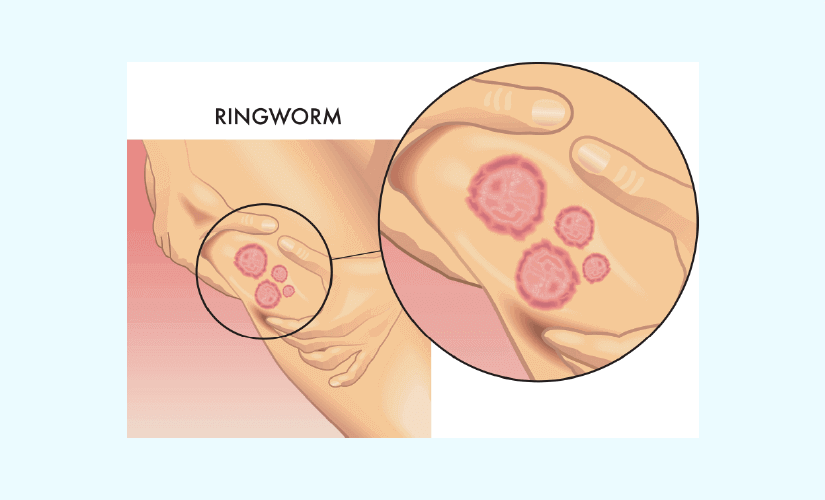 Natural Dog Ringworm Remedies | Home Treatment for Ringworm on Dogs