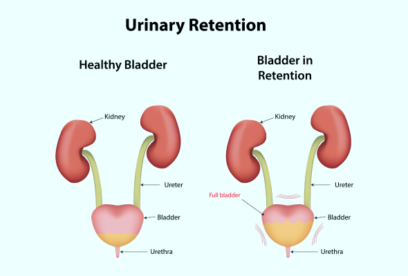 Urinary Retention: Symptoms, Causes, Diagnosis and Treatment